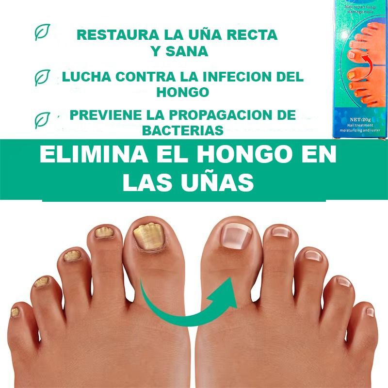 Crema para eliminar el hongo de las Uñas
