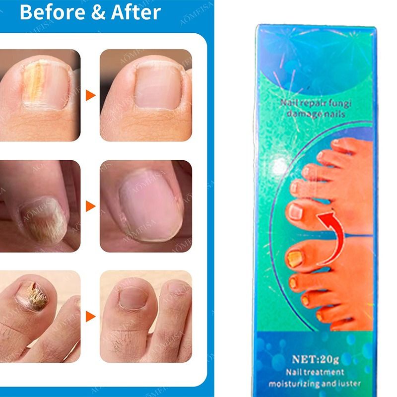 Crema para eliminar el hongo de las Uñas