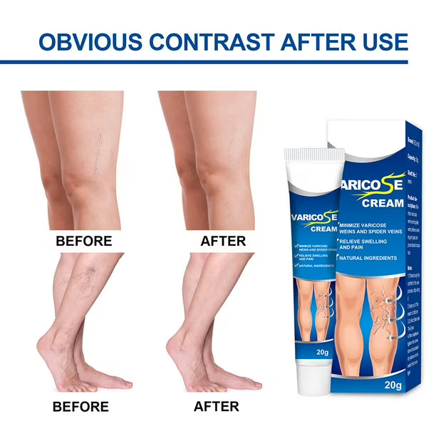 Crema para combatir las varices paga 1 lleva 2