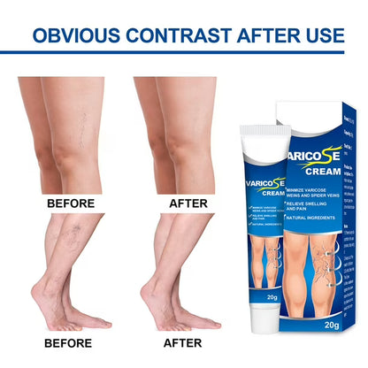 Crema para combatir las varices paga 1 lleva 2